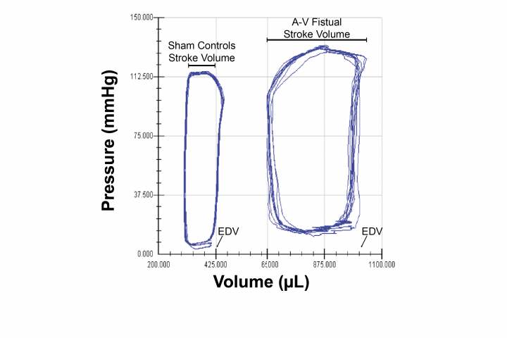 A-V Fistula : PV Loop